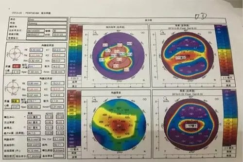正常的眼科OCT报告图