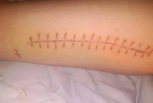 陈年疤痕能去掉吗