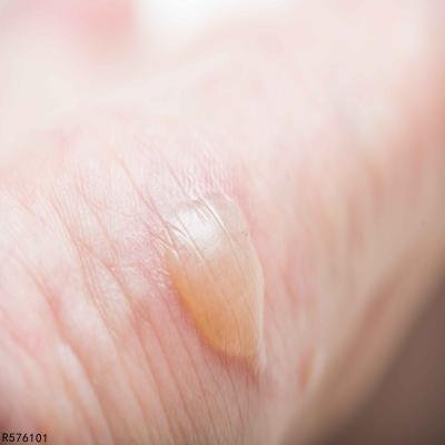 烫伤后的水泡怎么处理