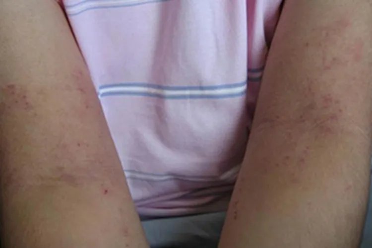 夏季皮炎症状图片