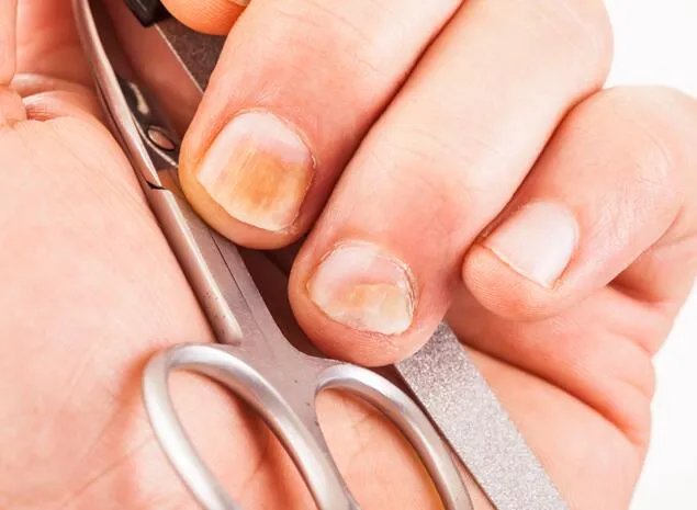 最轻微的灰指甲图 灰指甲轻微症状图片精选