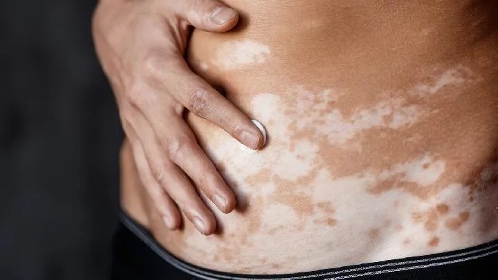 白癜风的发病原因有哪些