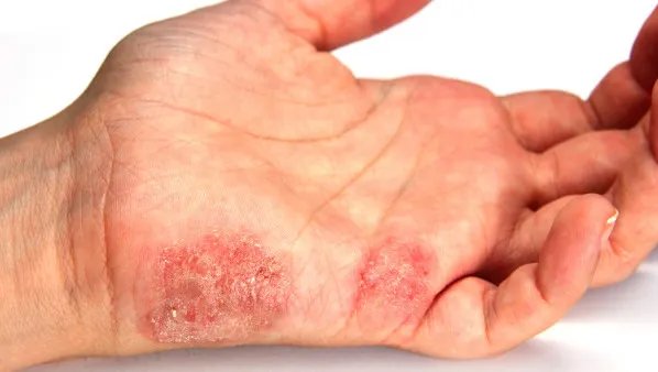 手癣传染吗