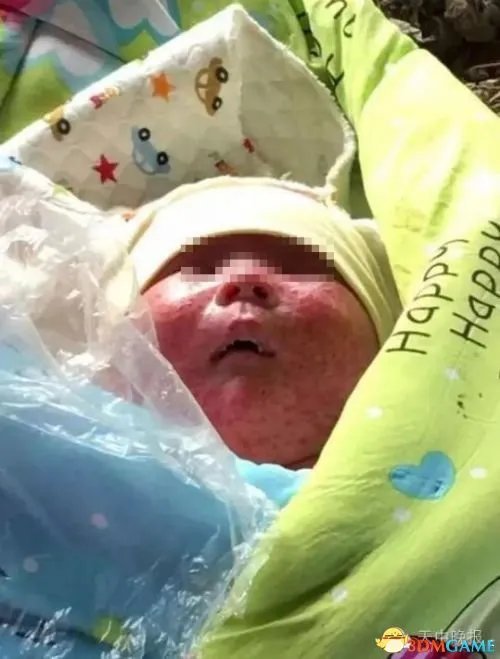 婴儿被弃爬满蚊虫 发热脱水口唇干燥布满红色斑疹