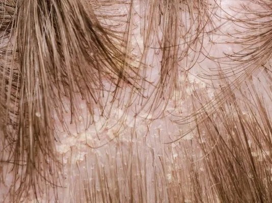 头皮屑大块的原因