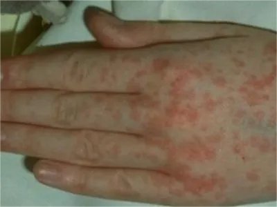 典型麻疹出疹期症状图片