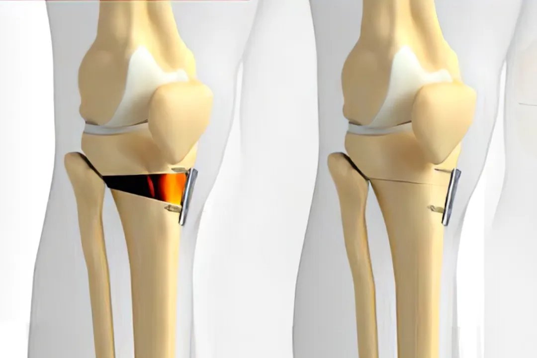 XO怎么变成直腿图解