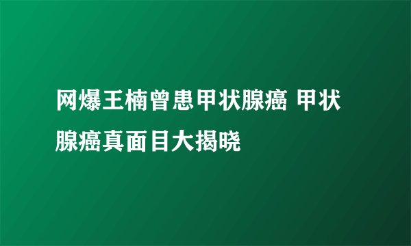 网爆王楠曾患甲状腺癌 甲状腺癌真面目大揭晓