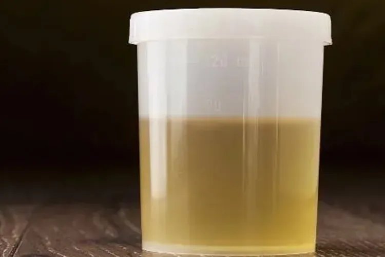 正常尿和泡沫尿图片