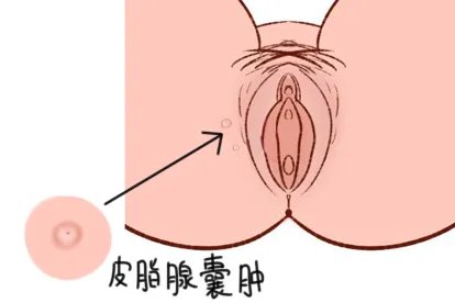 大腿根部粉瘤图片