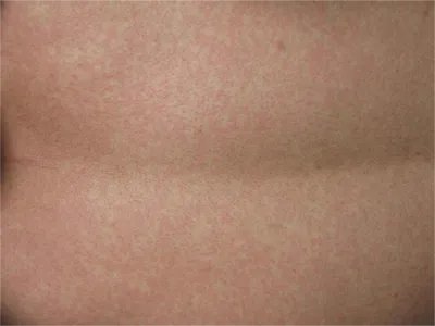 典型麻疹出疹期症状图片