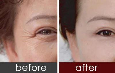 抗老除皱后的注意事项