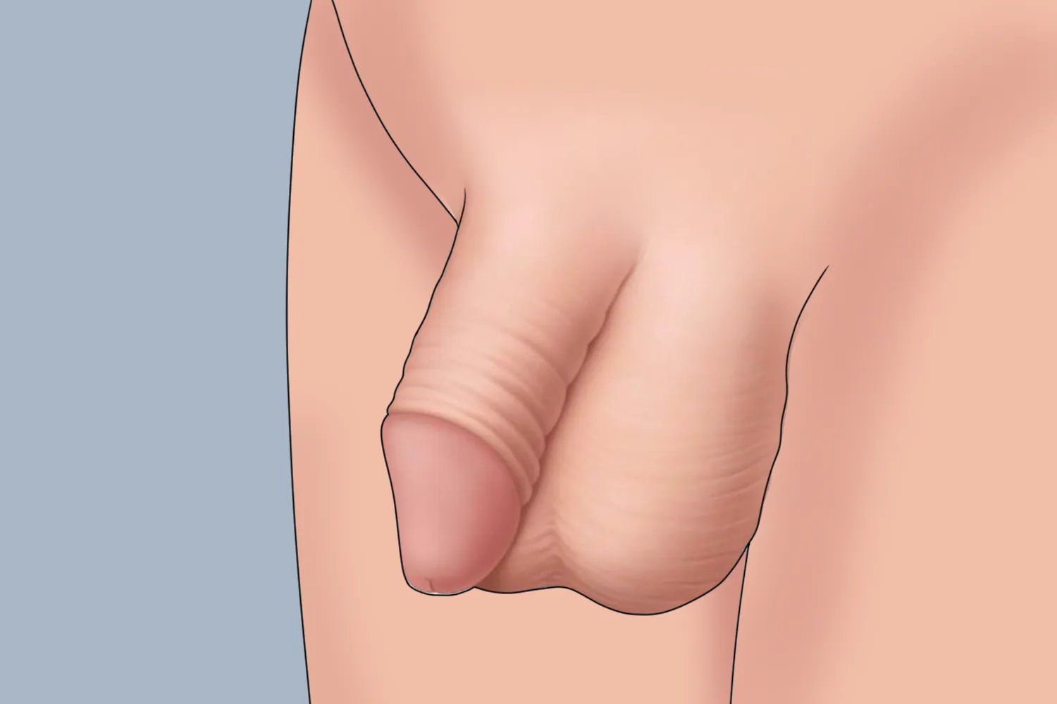 包皮手术恢复后图片