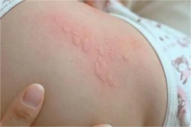 婴儿皮肤红疹图片