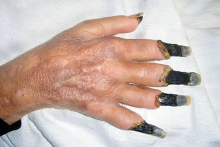 干性坏疽症状图片