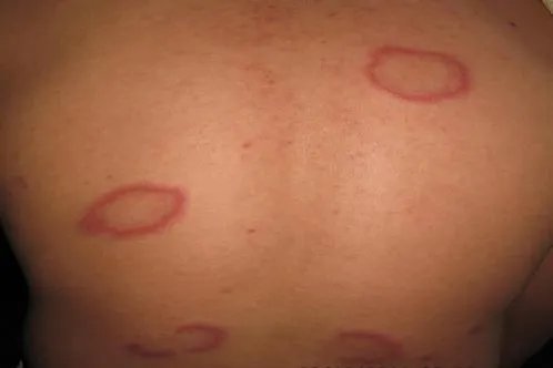 皮肤圈状红疹图片