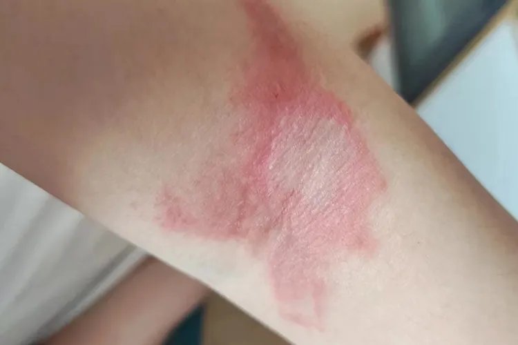 被隐翅虫咬后恢复过程图