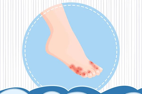 脚趾甲发黑是怎么回事