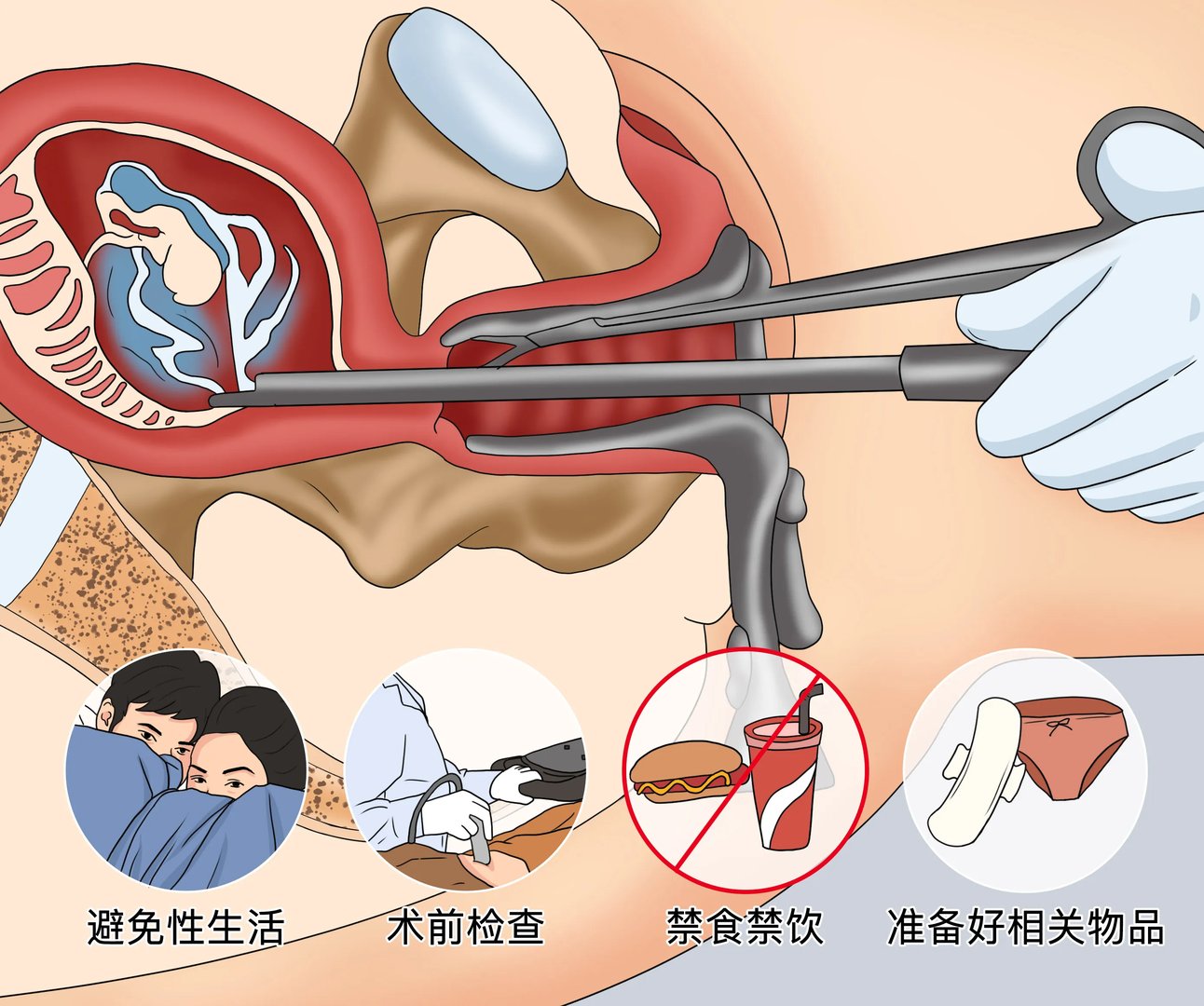 无痛人流需要准备什么