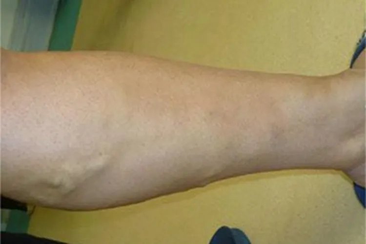 下肢静脉曲张小腿症状图片