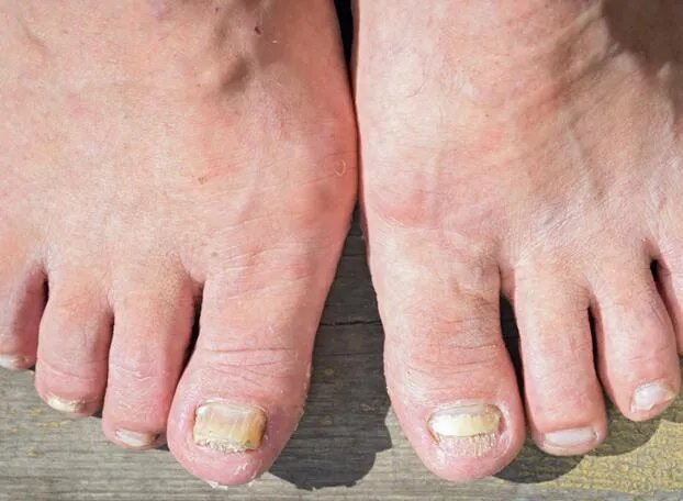 最轻微的灰指甲图 灰指甲轻微症状图片精选