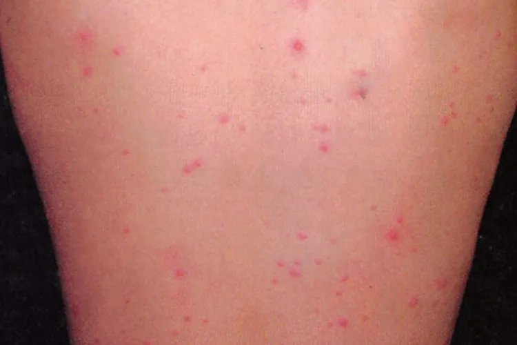 水痘初期症状图片,水痘一般年龄