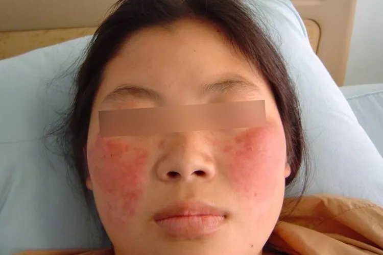 红斑狼疮对照图