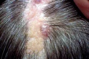 皮脂腺痣图片长什么样