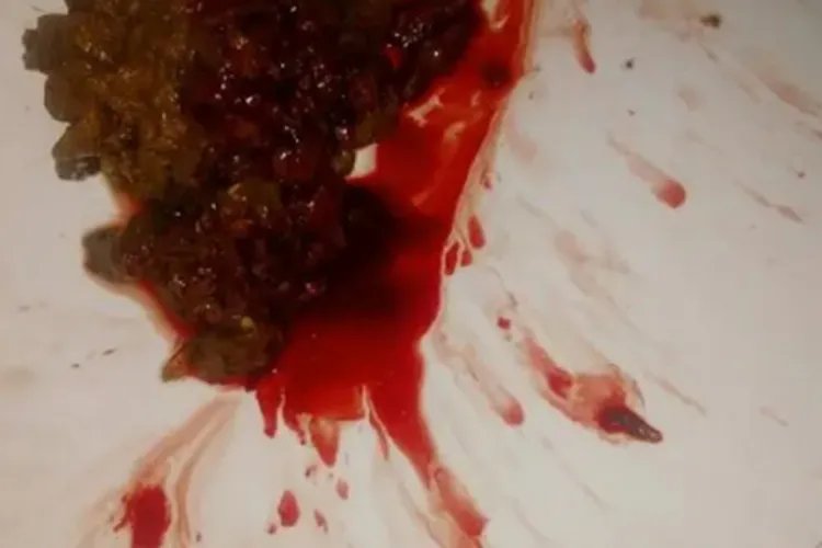 直肠癌早期黏液血便图片