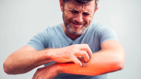 皮肤过敏了怎么办