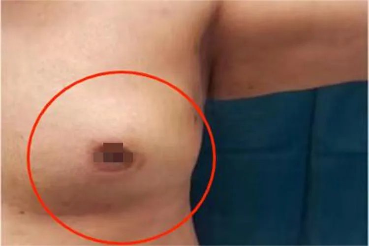 男性乳腺癌乳房肿图片