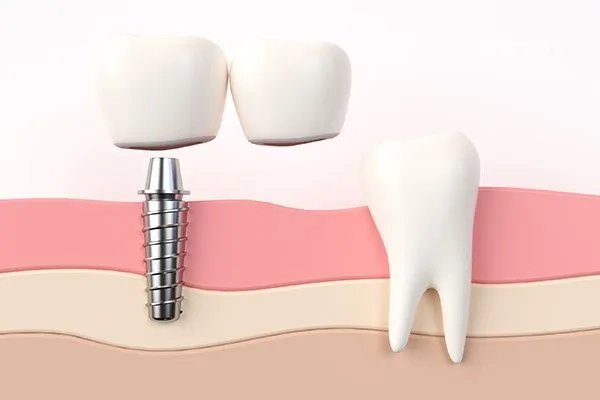 洗牙一次大概多少钱