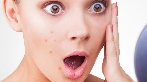 激光祛痘会反弹吗