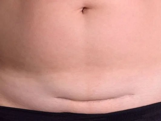 剖宫产后应如何护理