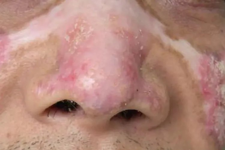 红斑狼疮对照图