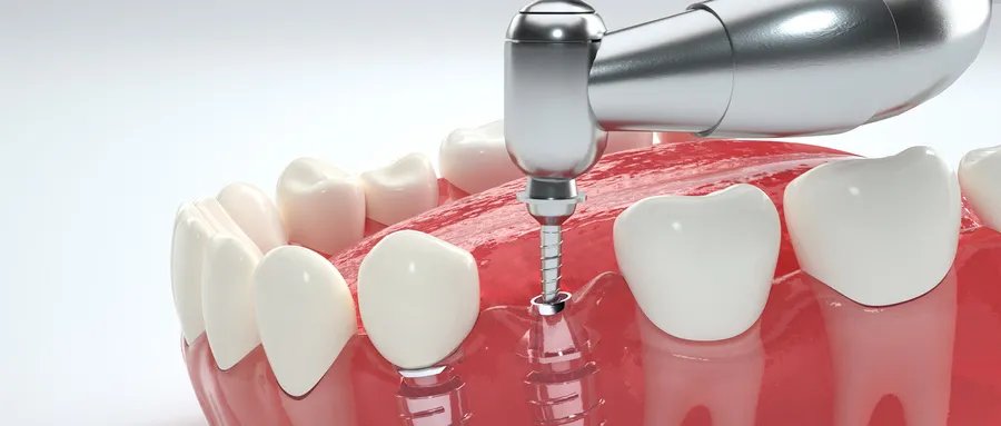 官方:暂未考虑将种植牙纳入医保 种植牙属于更高层次的医疗需求