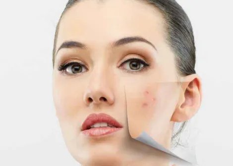 光子嫩肤去痘印优缺点