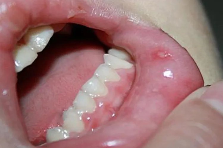 宝宝手足口病的症状图