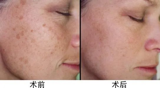 老年斑图片对比