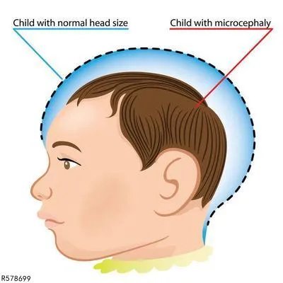 脑萎缩怎么预防 详述脑萎缩的几个预防方法