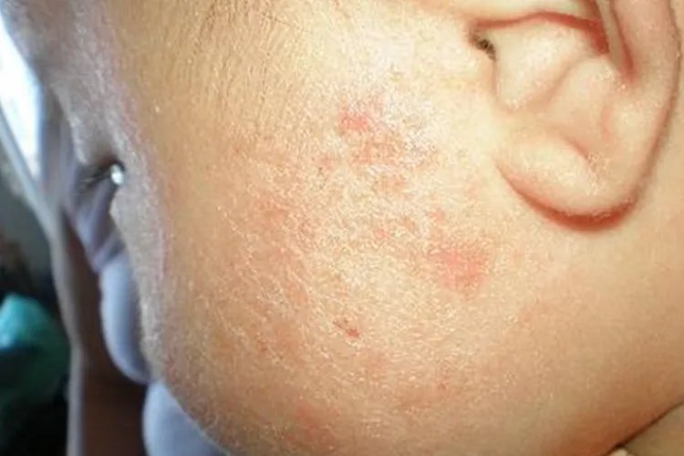 新生儿湿疹是什么样子图片