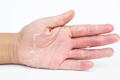 皮肤得了湿疹用什么药膏 用这四种药物可有效治湿疹