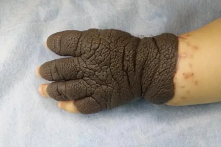 先天性巨痣手部症状图片