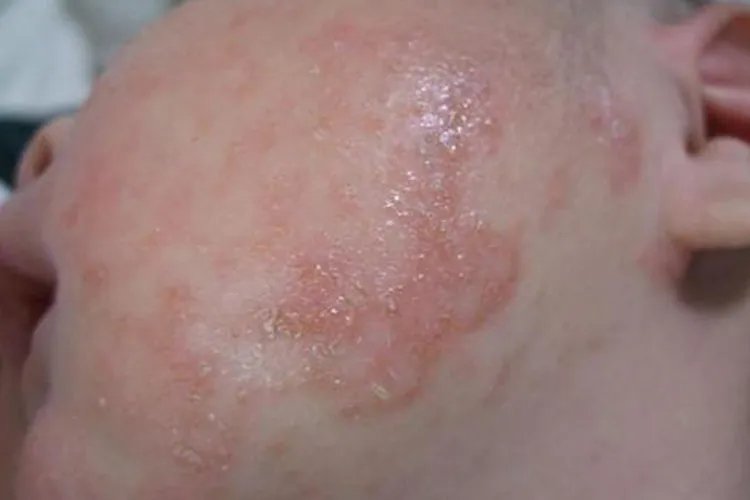 婴儿皮肤红疹图片