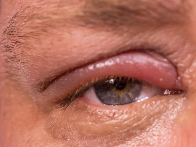 眼睑上长小颗粒的原因